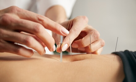 Needles are inserted into points on the meridians during acupuncture - Western Medicine vs TCM
